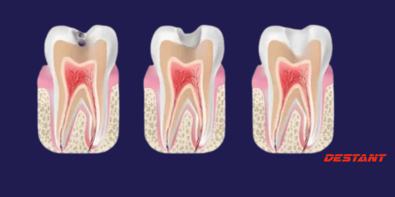 Get Rid of Cavities and Tooth Decay