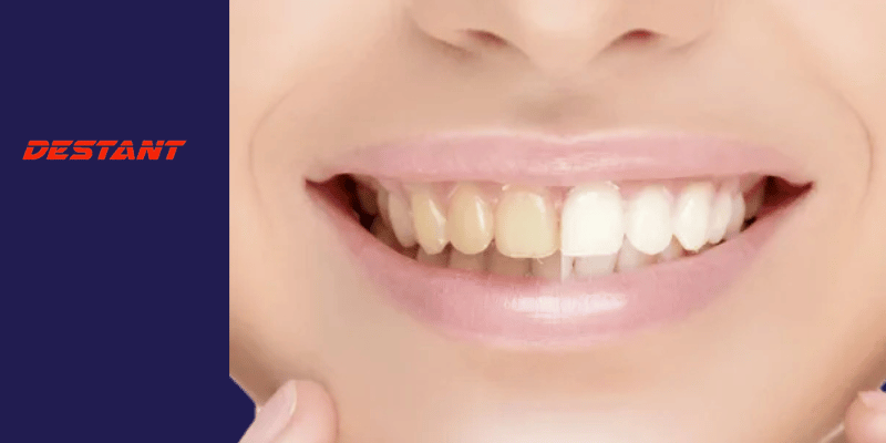 GUARANTEED! WHITEN YOUR YELLOW TEETH IN LESS THAN 2 MINUTES!