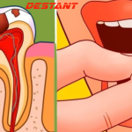 Get Rid of Cavities and Tooth Decay