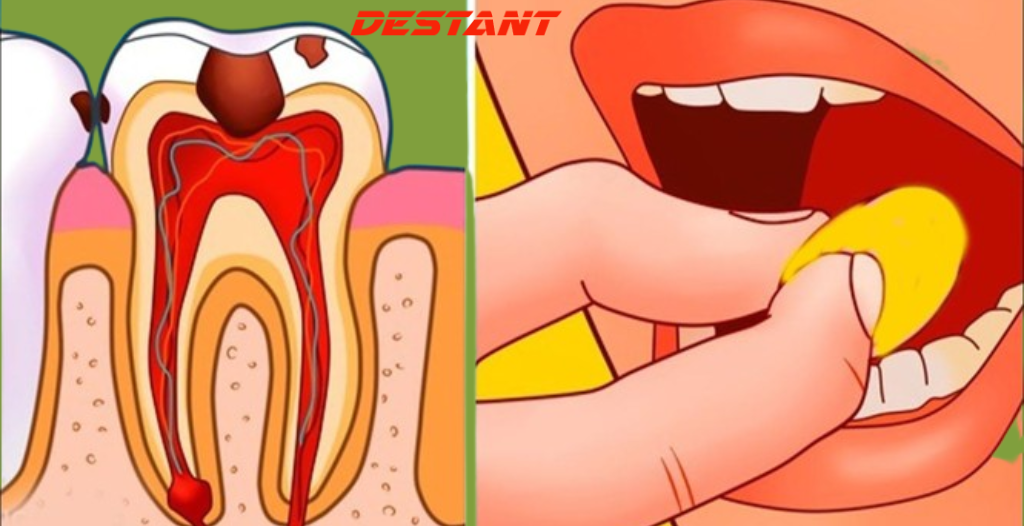 Get Rid of Cavities and Tooth Decay