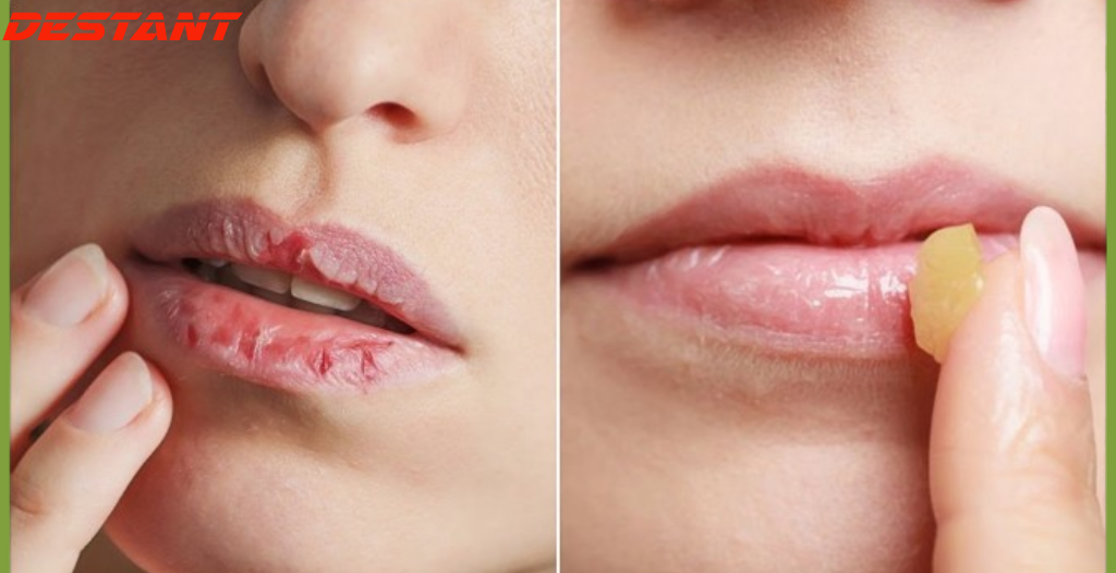 How To Get Rid Of Chapped Lips | How To Get Baby Soft Pink Lips In Just 3 Day Naturally At Home